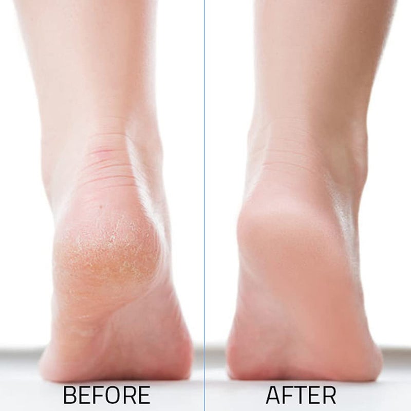 JAIRESTONE Pumice Stone - Callus Remover and Foot Stone Scrubber - Exfoliating Foot Stone Pumice Rock for Hard  Dry and Dead Skin on Heels  Body  Feet (Pack of 2) (White) - Image 3